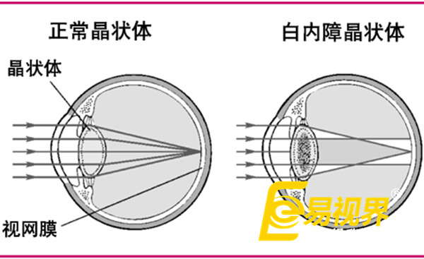 春節過量飲酒最傷眼 易視界