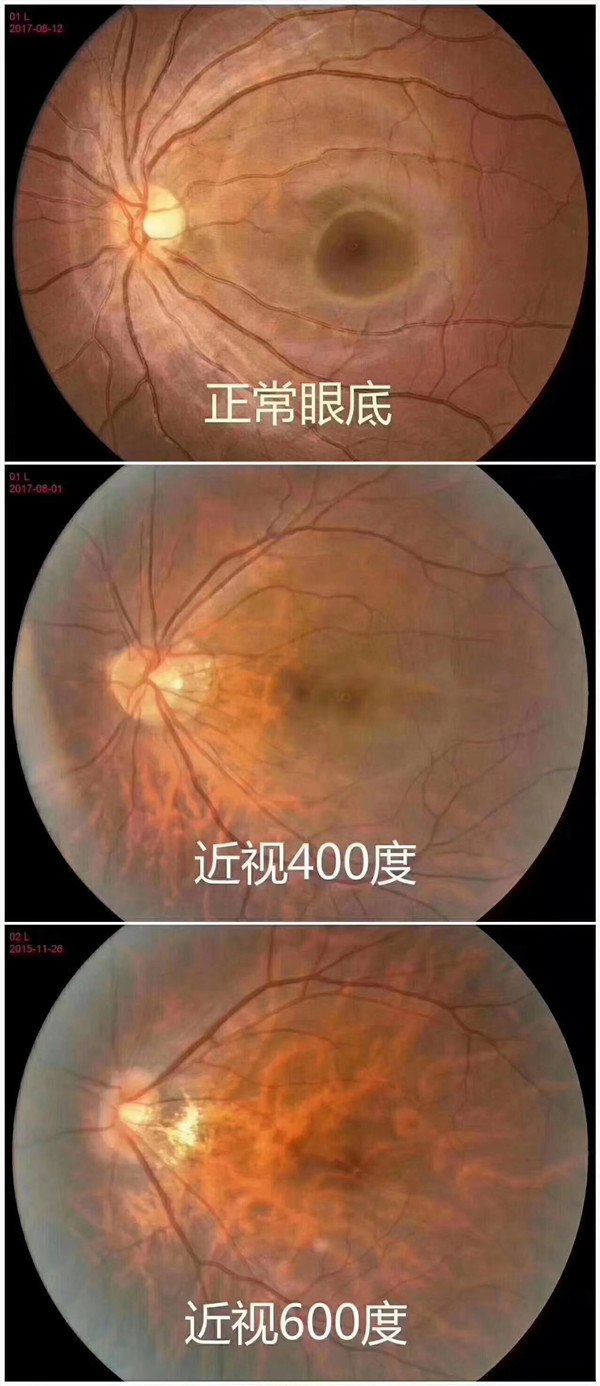 正常眼與近視眼的區別