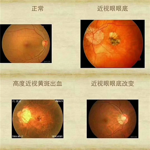 正常眼睛與高度近視的眼睛的區別