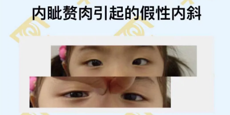 內眥贅肉引起的假性內斜