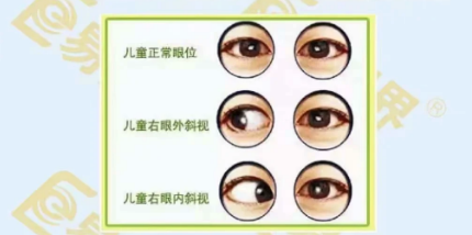 先天性斜視病因及發病機制