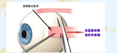 斜視手術需前需要滿足的條件