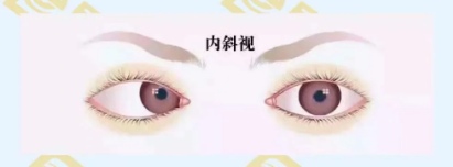 什么是調節性內斜視?