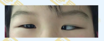 什么是先天性內斜視？