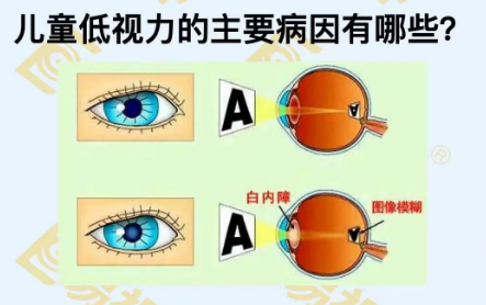 兒童低視力主要病因有哪些？