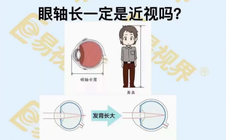 眼軸長(zhǎng)一定是近視嗎？