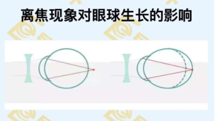 視網膜離焦對眼軸的影響