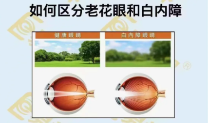 如何區分老花眼和白內障?