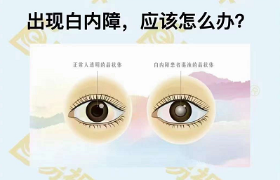 出現白內障應該怎么辦